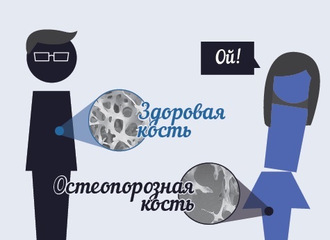 Остеопороз - одно из самых древних заболеваний
